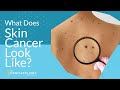 Skin Cancer Signs Mole