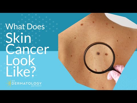 Video: This Is What A Cancerous Mole Looks Like