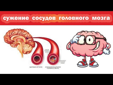 Лекарство от сужения сосудов головного мозга, мигрени, стенокардии, атеросклероза сосудов ног