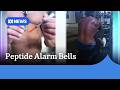 Abnormal moles seen developing in patients using peptide melanotan-II | ABC NEWS