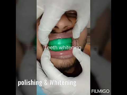 Teeth cleaning and bleaching cost in Kolkata