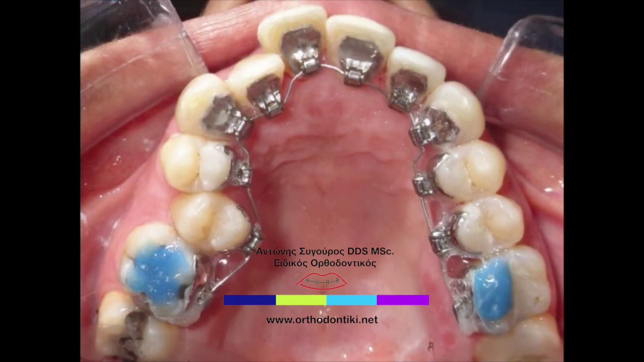 Γλωσσική Ορθοδοντική Εσωτερικά Σιδεράκια Lingual Orthodontics YouTube