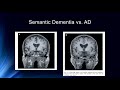 Neural Structures of Long Term Memory