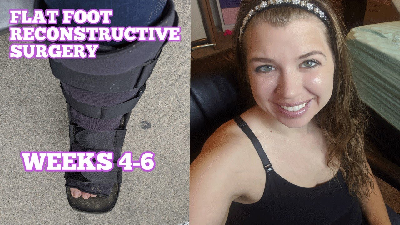 FLAT FOOT SURGERY WEEKS 46 SERIES 3 YouTube