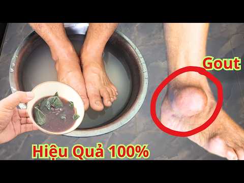 Phải Chi Tôi Biết Sớm Điều Này! Đau Nhức Do (Gout)Tăng Axit Uric Chỉ Cần Ngâm Chân Vào Thứ Này!