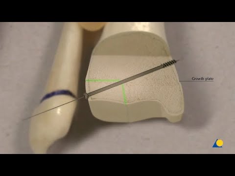 Video: Cum se remediază fractura triplanului?