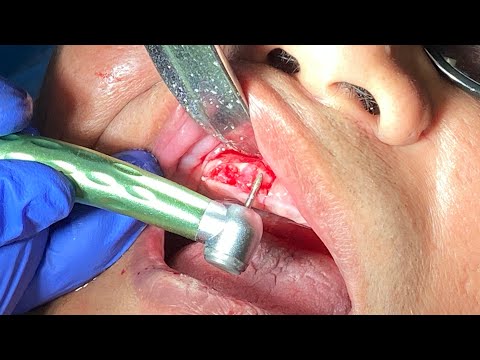 Video: Cum se scrie alveoloplastia?