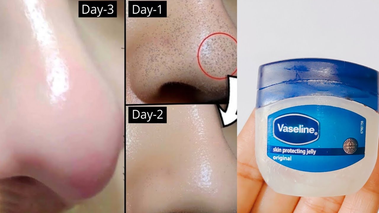 blackhead removal mask diy