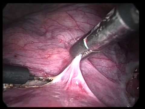 Laparoscopic Videos Miscl (edited-7)-LAVH