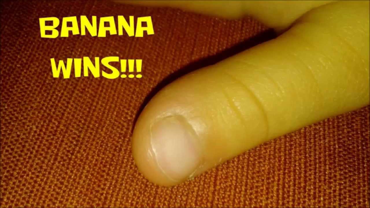 How to remove a finger wart with a banana peel Home Remedy YouTube