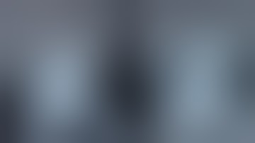 Lap pyeloplasty in crossed fused ectopic kidney @Pediatric-Urologist