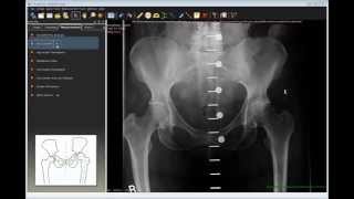 Using TraumaCad's Hip Outcome Tool Traumacad Cobb Angle