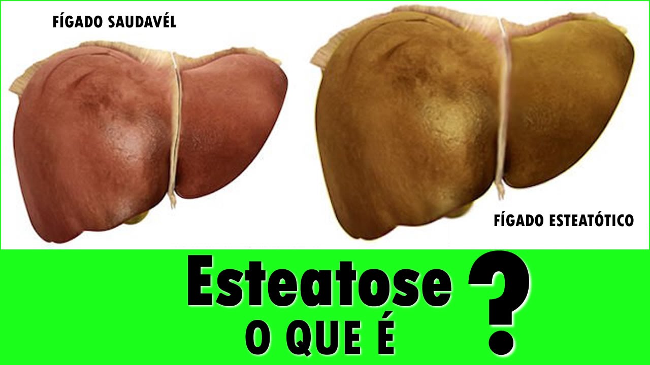 O que é Esteatose ? - YouTube