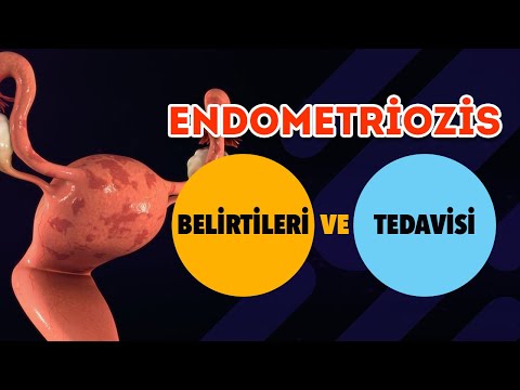 Endometriozis Nedir? Endometriozis Belirtileri ve Tedavisi - Prof. Dr. Gamze Sinem