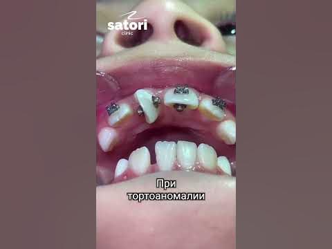 Цепочки для брекетов, чейны - YouTube