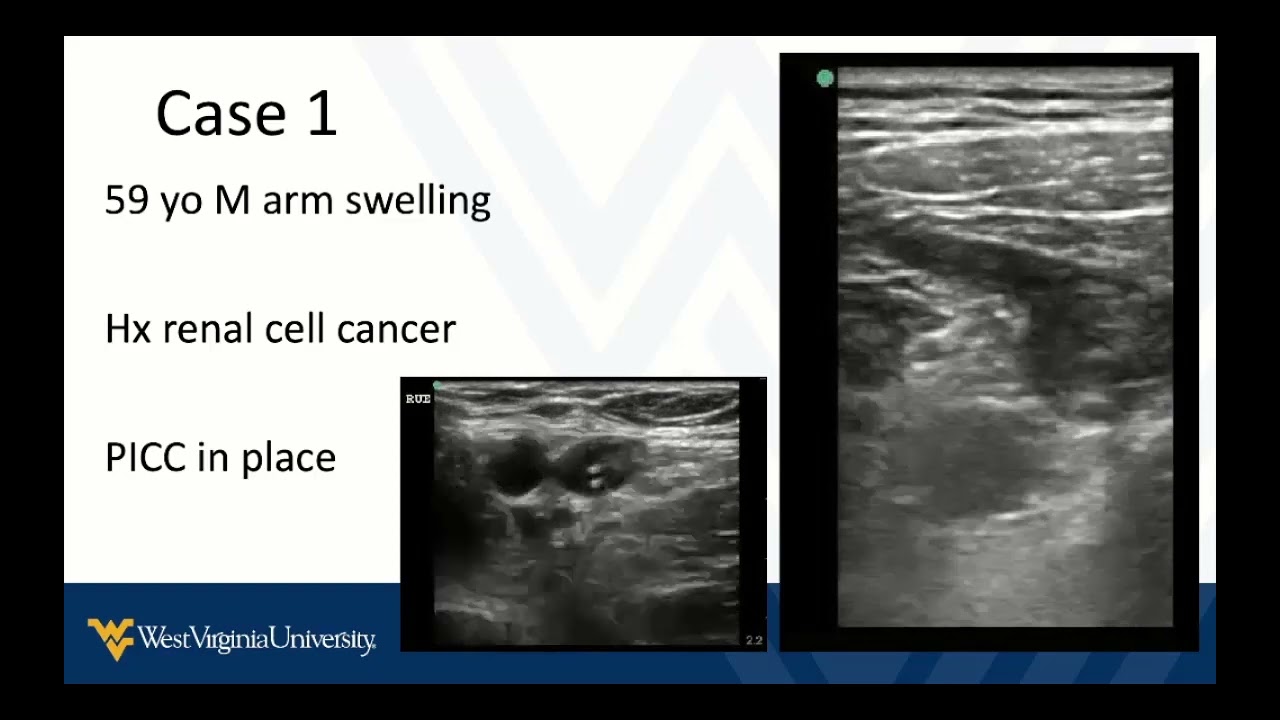 DVT POCUS 5 - Upper Extremity DVT and Summary