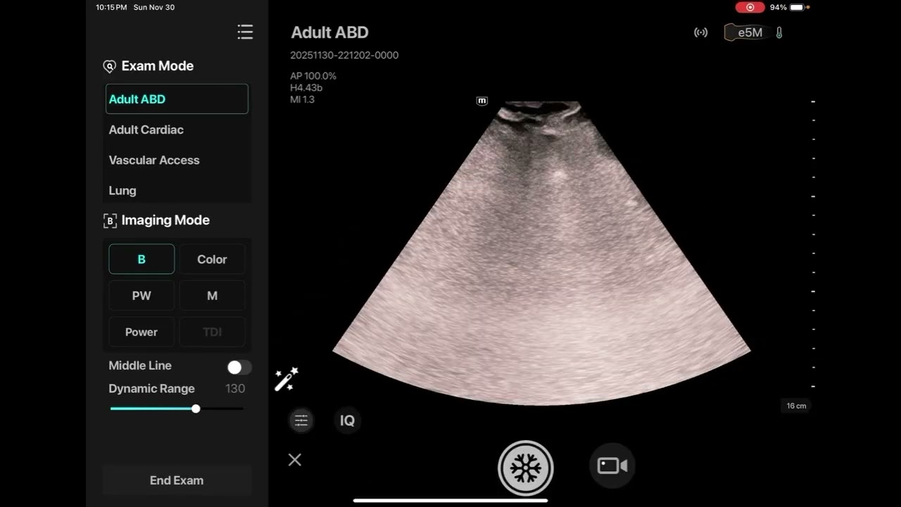 Mindray TE Air e5m: Comprehensive Review from Peachtree POCUS