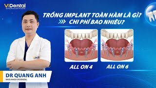 Trồng Răng Toàn Hàm All On 4, All On 6 Là Gì? Chi Phí Bao Nhiêu? | Nha Khoa ViDental