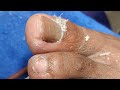 Pedicure Great #satisfying Neldz SOLO Parent  is live!