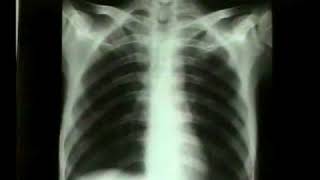 1. How to read a Chest X-Ray - Dr. Vaidya