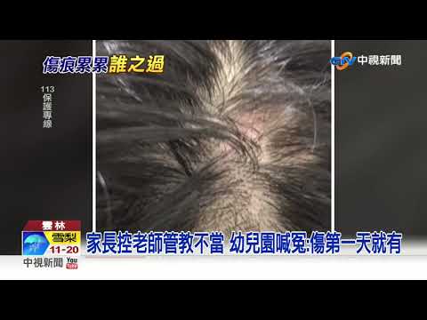 2歲男童渾身傷"老師用的"? 單親媽.幼兒園互控│中視新聞 20200924