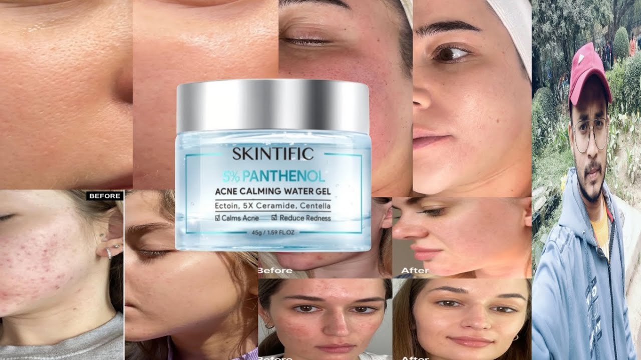 Skintific 5% Panthenol Acne Calming Water Gel | Honest Review