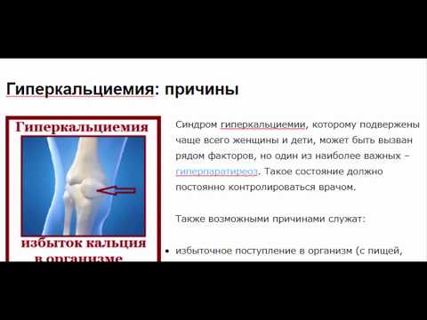 Что такое гиперкальциемия: особенности и признаки
