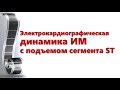 ЭКГ-динамика ИМпST