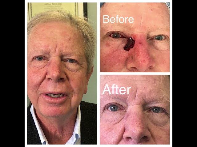 Eyelid Skin Cancer Reconstruction Surgery
