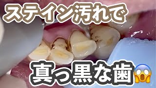 【閲覧注意】1日紙タバコ15本でステインびっちり！真っ黒になった歯のステイン＆歯石除去