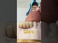 インプラントブリッジ治療を先生が解説！#shorts