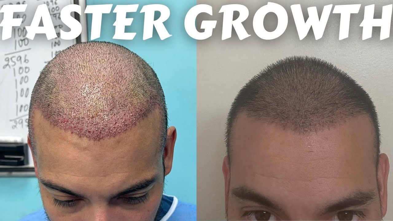 Speeding Up Hair Transplant Growth *My Regimen YouTube