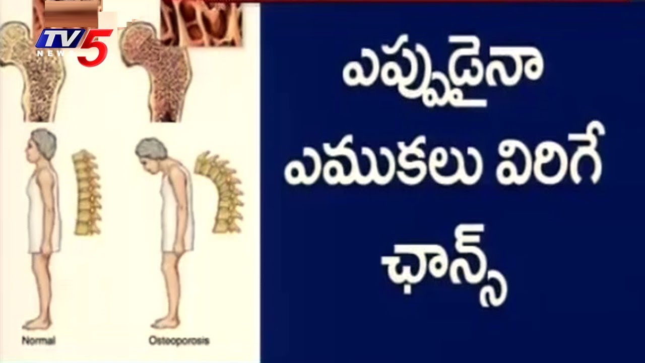 World Osteoporosis Day 2017 Awareness Of Osteoporosis Tv5 News Youtube