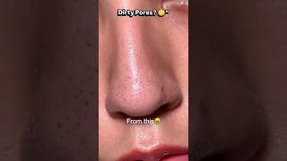 Blackheads Removal 😳 | Clean Nose Result ✨
