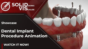 Dental Implant Procedure - Solidworks Visualize Animation