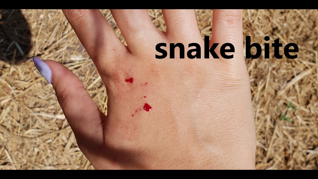 נשיכת נחש Snake bite YouTube