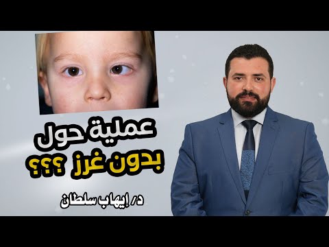 هل ممكن عملية الحول تتعمل بدون غرز د إيهاب سلطان