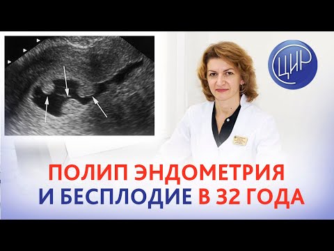 Полип эндометрия и бесплодие в 32 года. Дементьева С.Н.