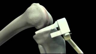 Conformis iUni - Unicompartmental Knee Implant