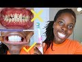 Oral Hygiene 101 | Avoid Gingivitis with this 1 trick | Healthy Gums | White smile