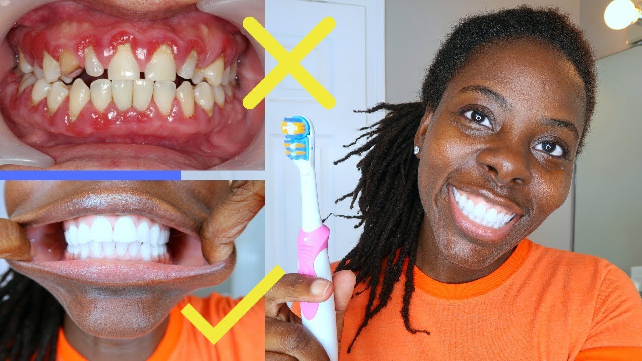 Oral Hygiene 101 Avoid Gingivitis with this 1 trick Healthy Gums