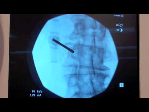 Compression Fracture? Watch a Balloon Assisted Vertebral Augmentation - Live
