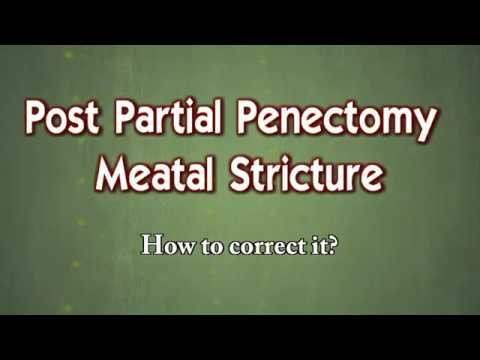 Reconstruction of post partial penectomy meatal stricture