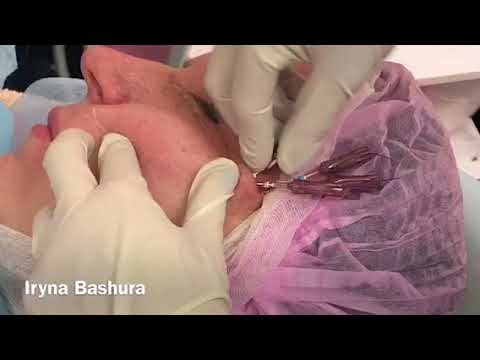 Ultimate Bashura максимальный лифтинг