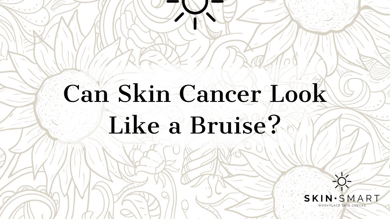 Can skin cancer look like a bruise? YouTube