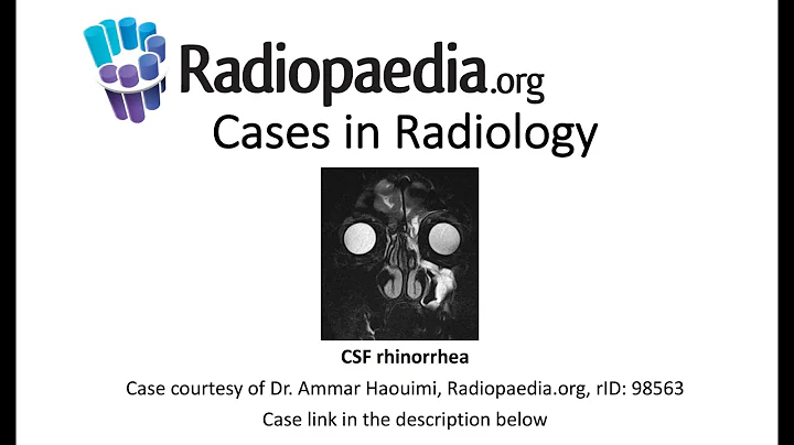 CSF rhinorrhea (Radiopaedia.org) Cases in Radiology