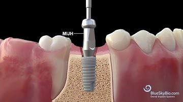 BSB Scannable Analog