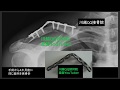 鎖骨骨折　手術失敗の実例　患者＆医療系必見！
