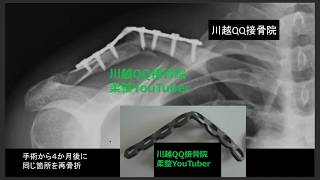 鎖骨骨折　手術失敗の実例　患者＆医療系必見！