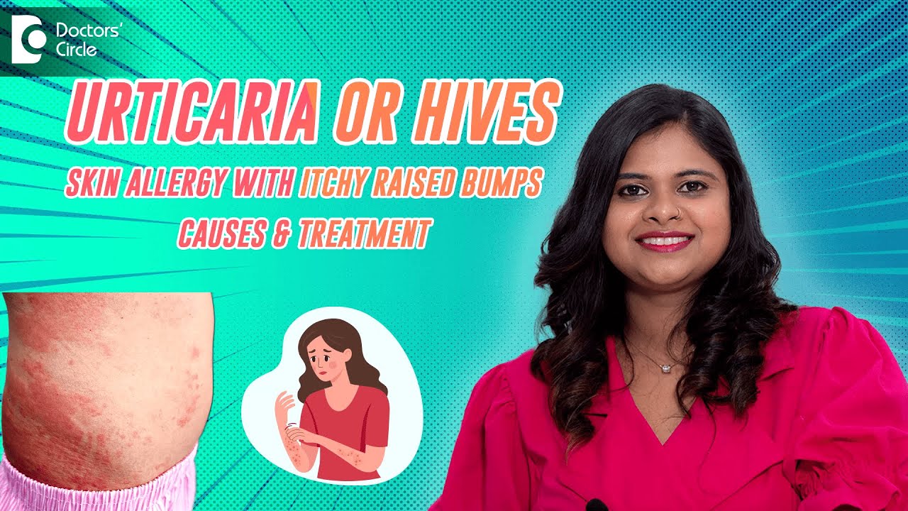 Hives on skin | Skin Allergy |Best Treatment for skin #allergy | # ...
